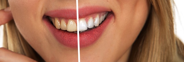 歯科矯正を受ける人に「ホワイトニング」をおすすめする理由