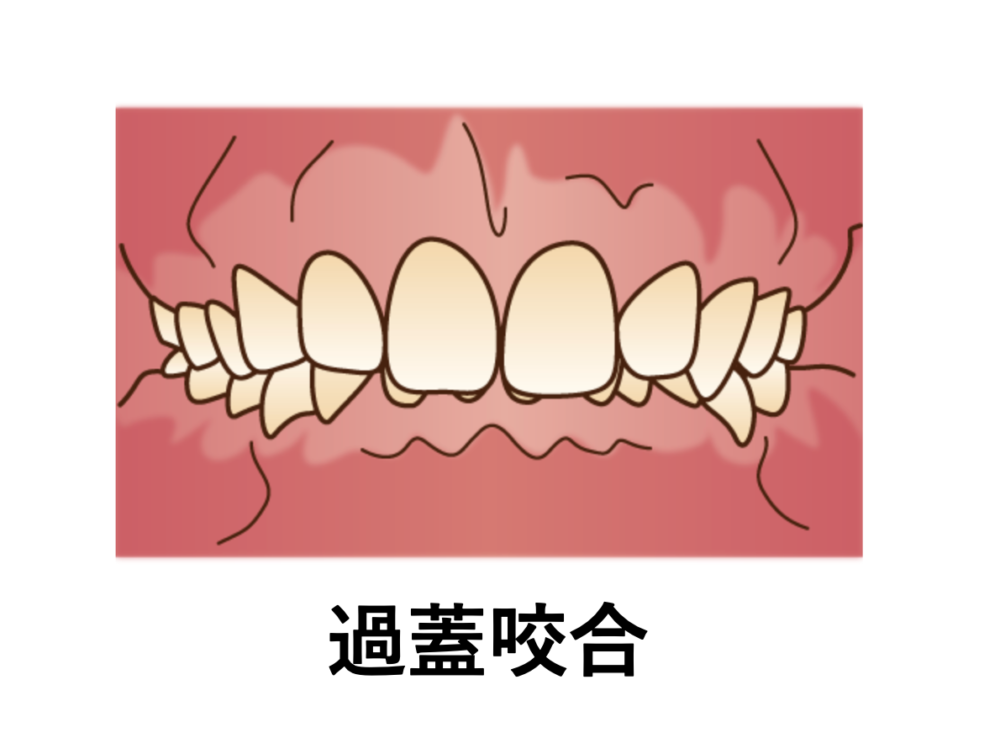 矯正で歯が動きにくい過蓋咬合の歯