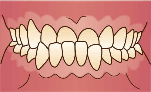 噛み合わせが逆「反対咬合」