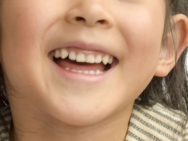 「八重歯」はチャームポイント？歯科矯正をするべきかどうか
