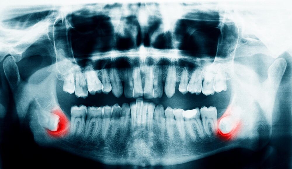歯列矯正中に親知らずが生えたらどうする？抜歯によるメリット・デメリット