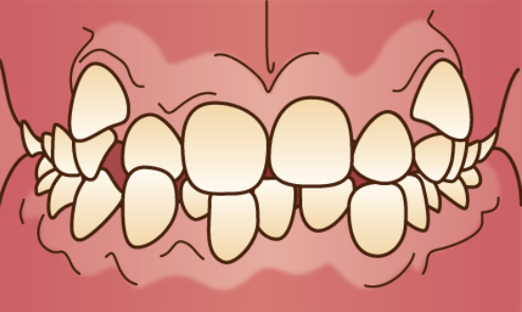 歯がデコボコに生えている「叢生（そうせい）」のイラスト